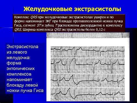 Определение неспецифического нарушения ЭКГ