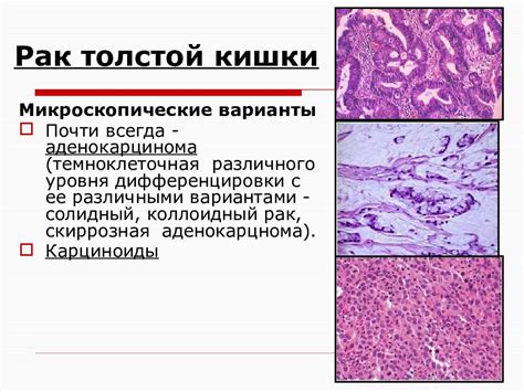 Определение низкодифференцированной аденокарциномы толстой кишки g3