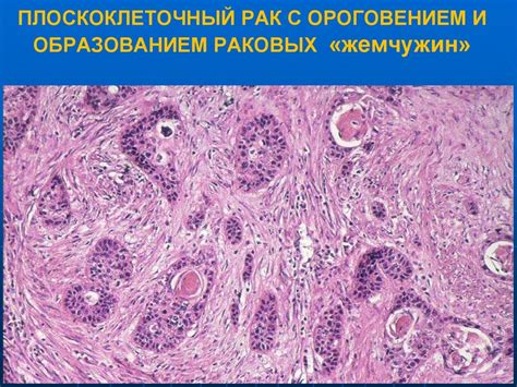 Определение низкодифференцированной опухоли