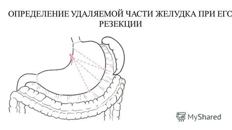 Определение нормацидности желудка