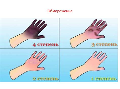 Определение обморожения 2 степени