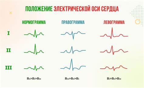 Определение отклонения ЭОС влево на ЭКГ