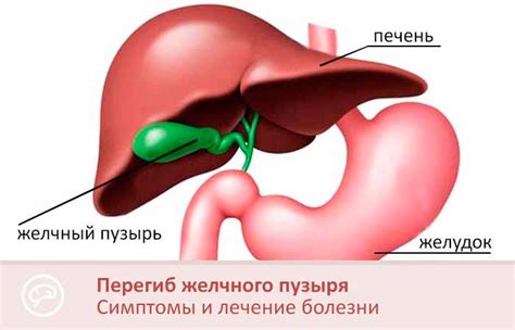 Определение перегиба тела желчного пузыря