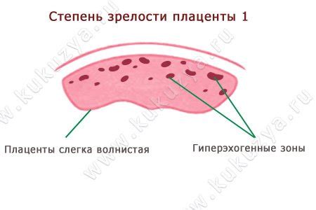 Определение плаценты 1 степени зрелости