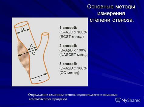 Определение стеноза ПМЖВ