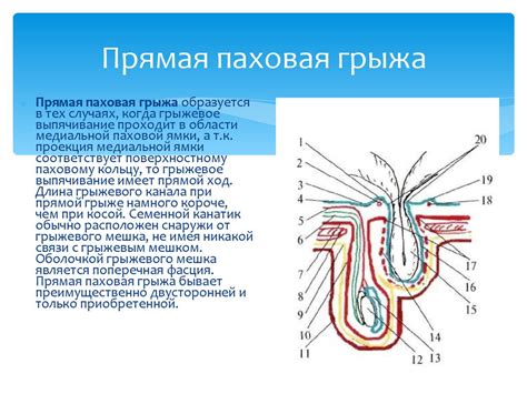 Определение типа грыжи