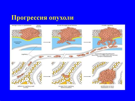 Определение типа опухоли