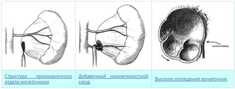 Определение щелевидной лоханки