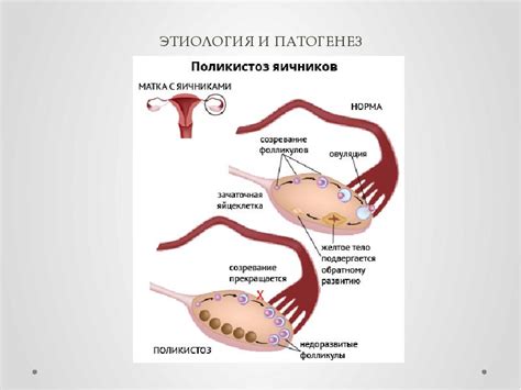 Определение эндометрия эхопозитивного