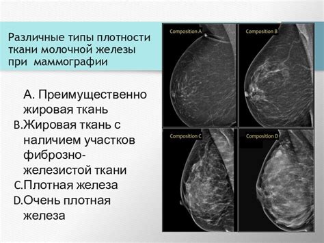 Определение 3-го типа плотности ткани молочной железы