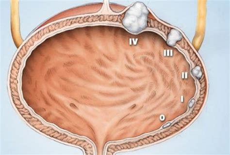 Опухоли мочевого пузыря