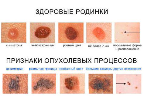 Опухоль в виде кратера: что это и как выглядит?