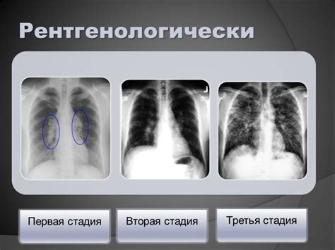 Осложнения, возникающие при плевропульмональных тяжах