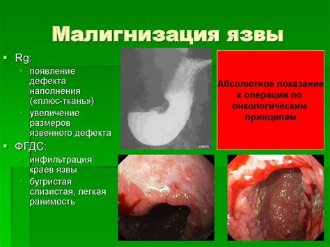 Осложнения выраженного угла желудка