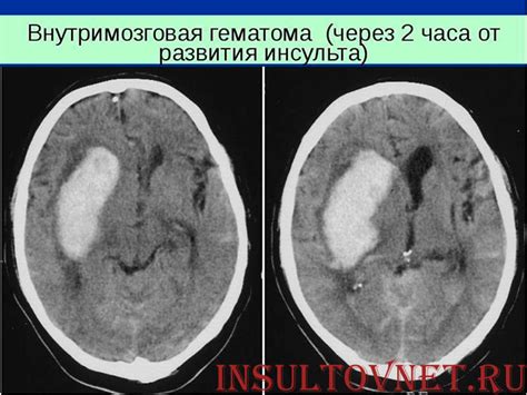 Осложнения геморрагического инсульта: как ими предотвратить