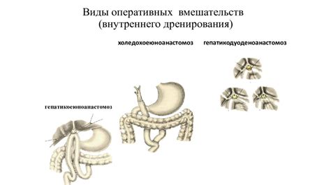 Осложнения гепатохоледоха 4 мм