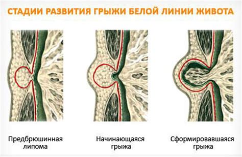 Осложнения грыжи живота и возможные последствия