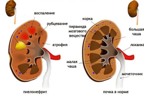 Осложнения губчатой почки