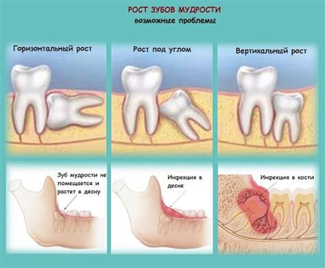 Осложнения и последствия лечения зуба мудрости