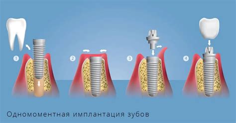 Осложнения и преимущества установки импланта