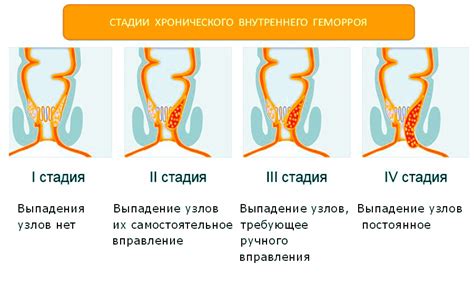 Осложнения комбинированного геморроя 4 степени