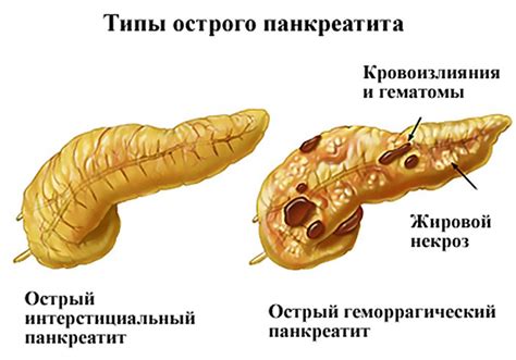 Осложнения острого неуточненного панкреатита