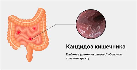 Осложнения при лечении сквозного кишечника