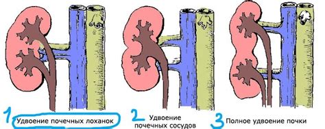 Осложнения при удвоении левой почки