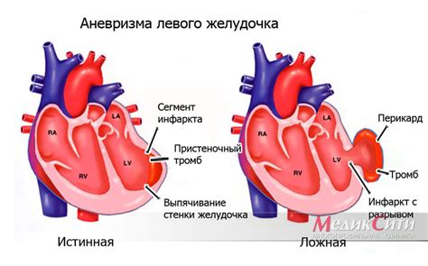 Осложнения раздвоенного сердца