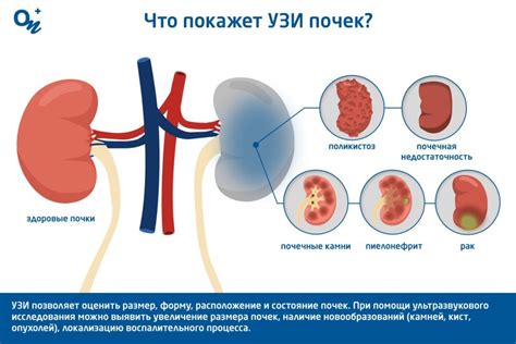 Осложнения расширения чашечек почек