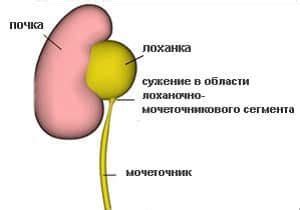 Осложнения расширенной почечной лоханки