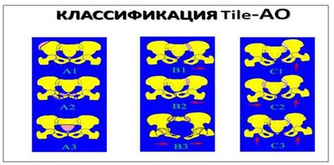 Осложнения стрельчатого крестца