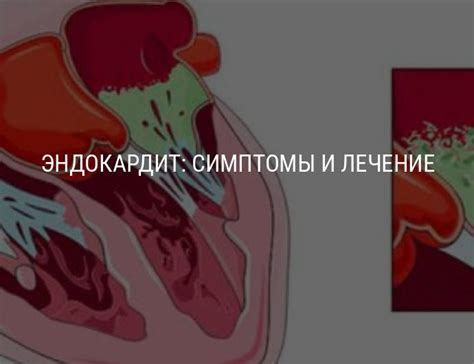 Осложнения эндокардита и их последствия