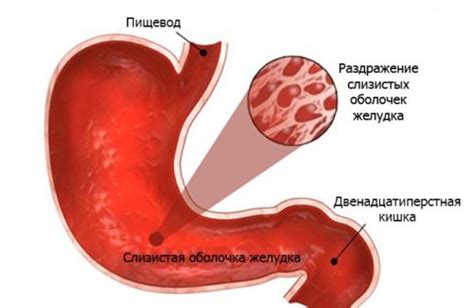 Осложнения эритематозной гастродуоденопатии