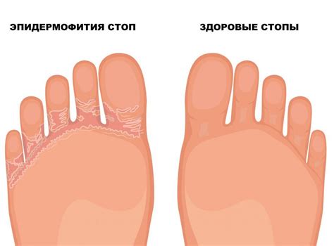 Основные методы лечения и предупреждения роста ногтей вверх