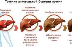 Основные подходы в лечении умеренных диффузных изменений печени у женщин