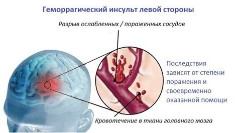 Основные последствия геморрагического инсульта