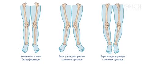 Основные последствия проникновения пули в колено