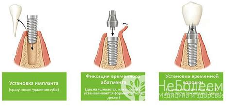 Основные преимущества куф эндоурального протезирования