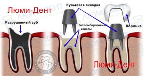 Основные преимущества штифтовых зубов