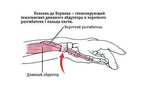 Основные признаки и проявления синдрома де Кервена