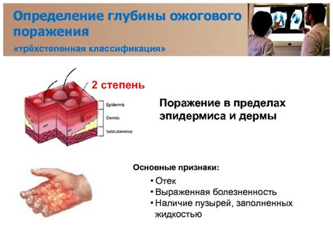 Основные признаки ожогового пузыря