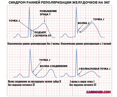 Основные признаки пограничного состояния на ЭКГ