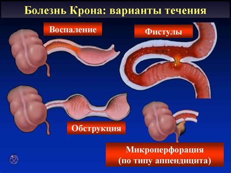 Основные принципы санации кишечника трихопол