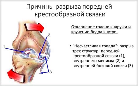 Основные причины разволокнения передней крестообразной связки