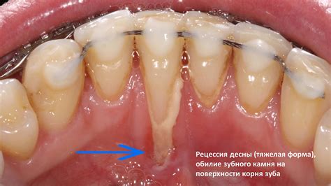 Основные причины рецессии десен