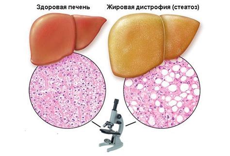 Основные причины снижения плотности паренхимы печени