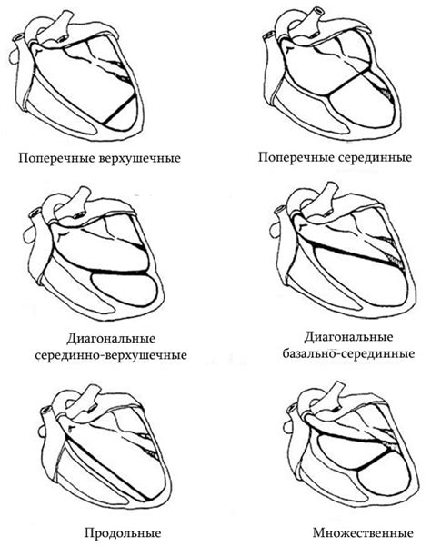 Основные симптомы аномально расположенной хорды