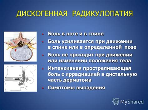 Основные симптомы вертеброгенной радикулопатии