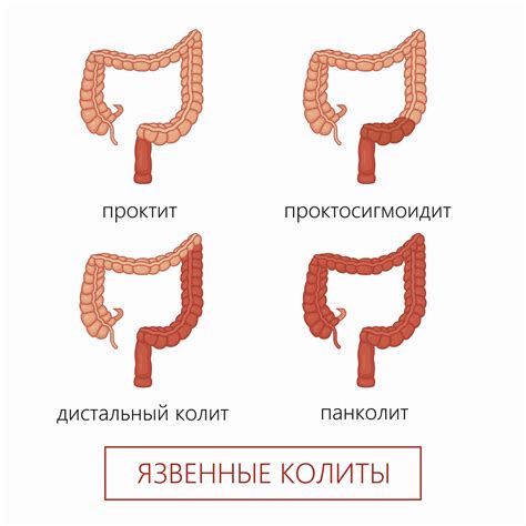 Основные симптомы гипотонического колита кишечника